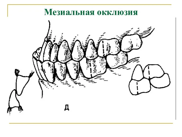 Мезиальная окклюзия