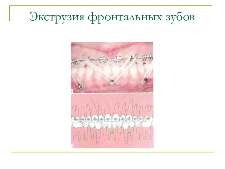 Экструзия фронтальных зубов
