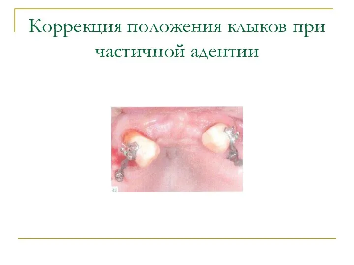 Коррекция положения клыков при частичной адентии