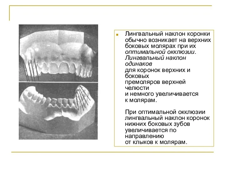 Лингвальный наклон коронки обычно возникает на верхних боковых молярах при их