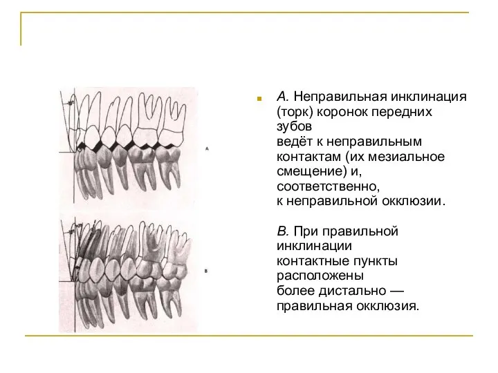 А. Неправильная инклинация (торк) коронок передних зубов ведёт к неправильным контактам