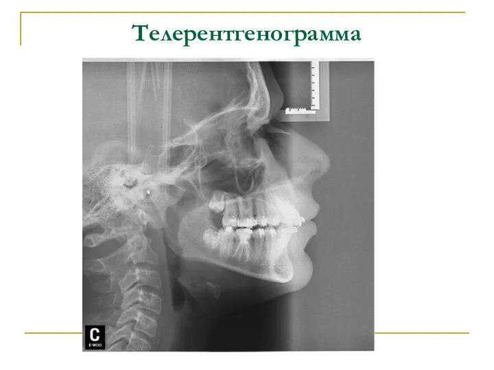 Телерентгенограмма