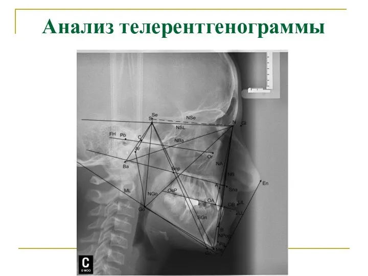 Анализ телерентгенограммы