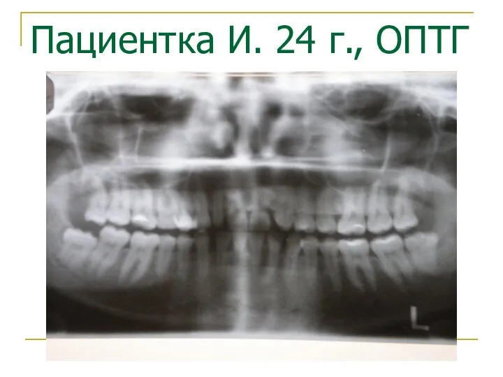 Пациентка И. 24 г., ОПТГ