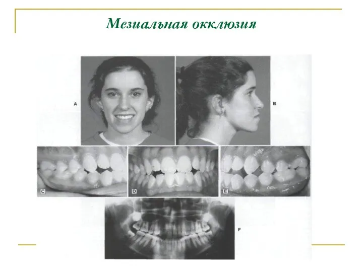 Мезиальная окклюзия