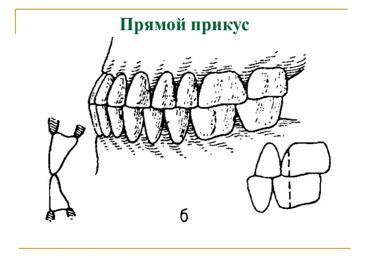 Прямой прикус