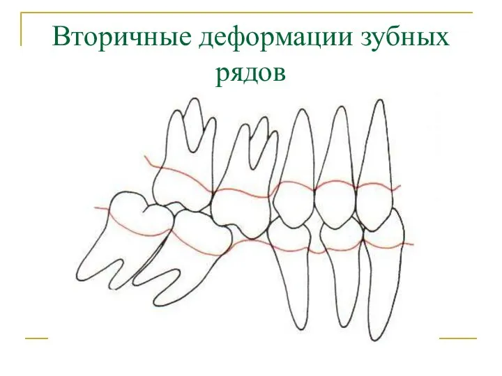 Вторичные деформации зубных рядов