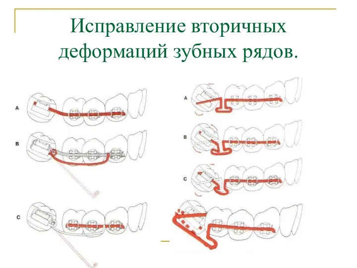 Исправление вторичных деформаций зубных рядов.