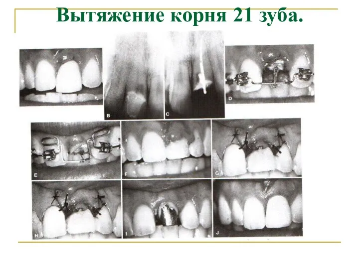 Вытяжение корня 21 зуба.