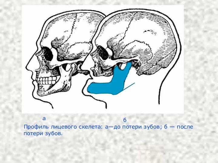 Профиль лицевого скелета: а—до потери зубов; б — после потери зубов. а б