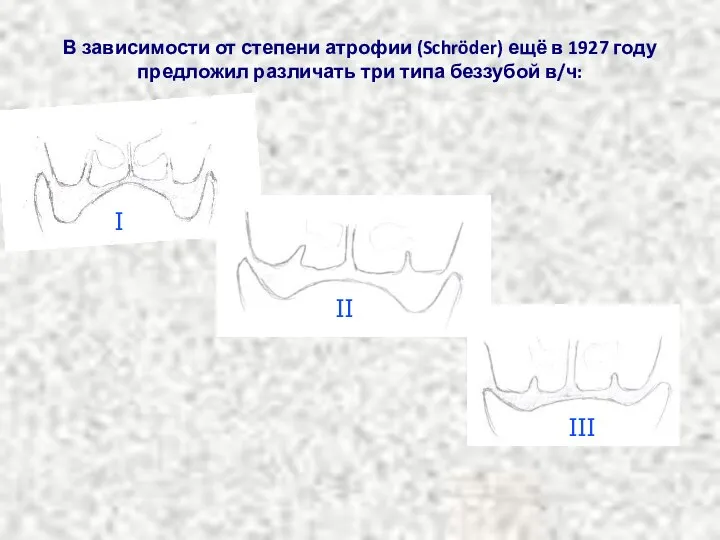 В зависимости от степени атрофии (Schröder) ещё в 1927 году предложил