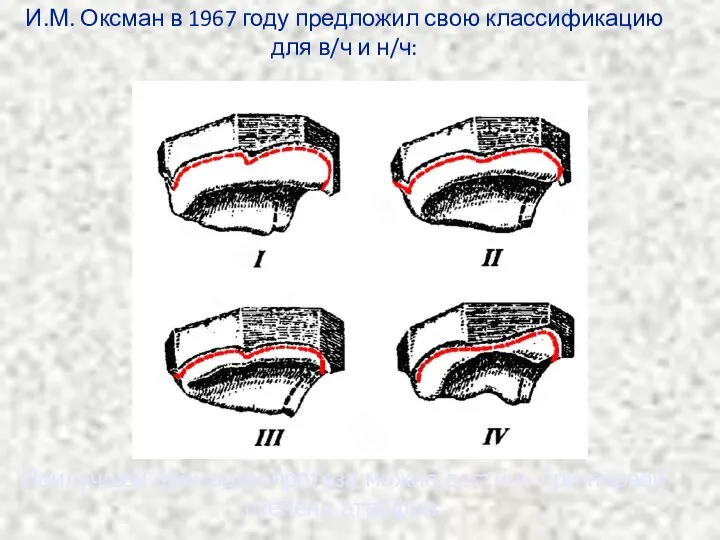 И.М. Оксман в 1967 году предложил свою классификацию для в/ч и