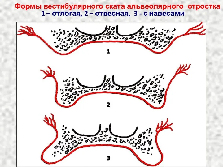 Формы вестибулярного ската альвеолярного отростка 1 – отлогая, 2 – отвесная, 3 - с навесами