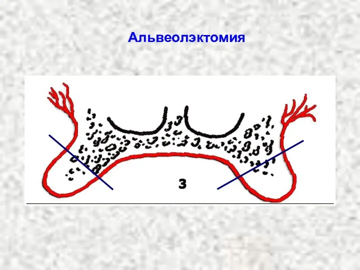 Альвеолэктомия