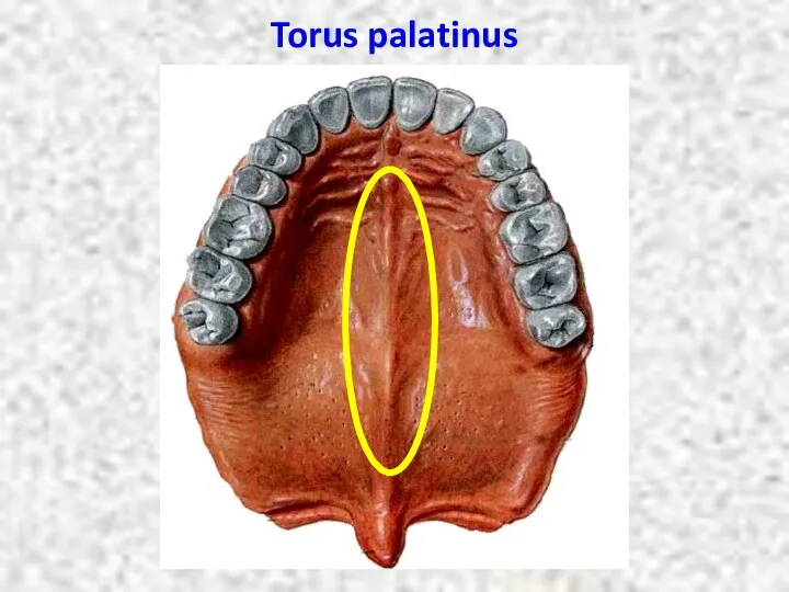 Torus palatinus