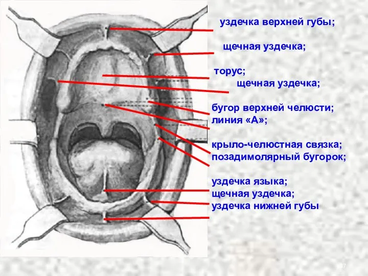 уздечка верхней губы; щечная уздечка; торус; щечная уздечка; бугор верхней челюсти;