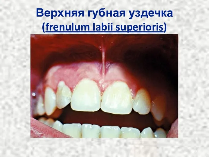 Верхняя губная уздечка (frenulum labii superioris)