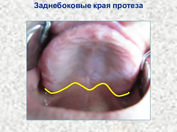 Заднебоковые края протеза