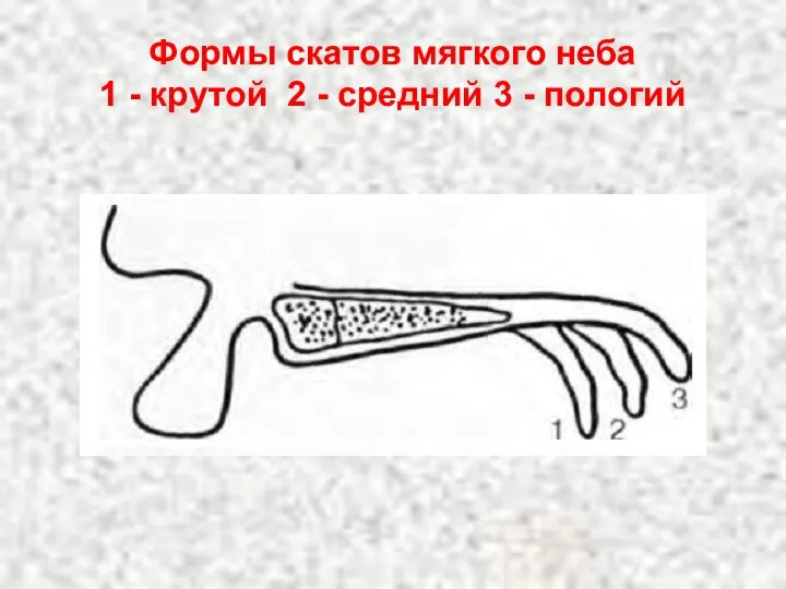 Формы скатов мягкого неба 1 - крутой 2 - средний 3 - пологий