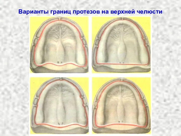 Варианты границ протезов на верхней челюсти