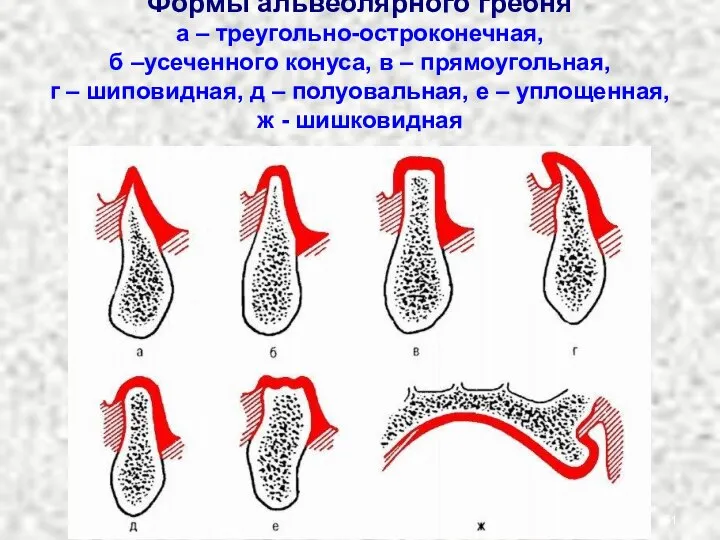 Формы альвеолярного гребня а – треугольно-остроконечная, б –усеченного конуса, в –