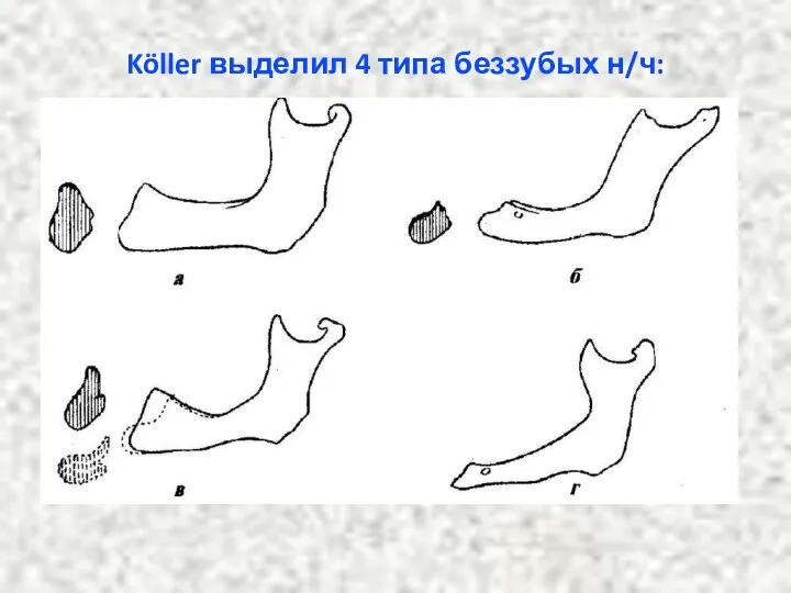 Köller выделил 4 типа беззубых н/ч: