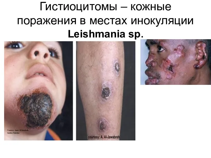 Гистиоцитомы – кожные поражения в местах инокуляции Leishmania sp.