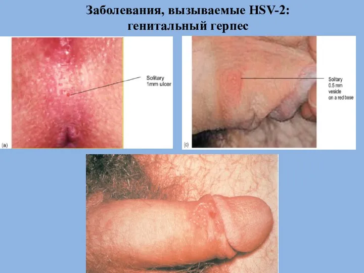 Заболевания, вызываемые HSV-2: генитальный герпес