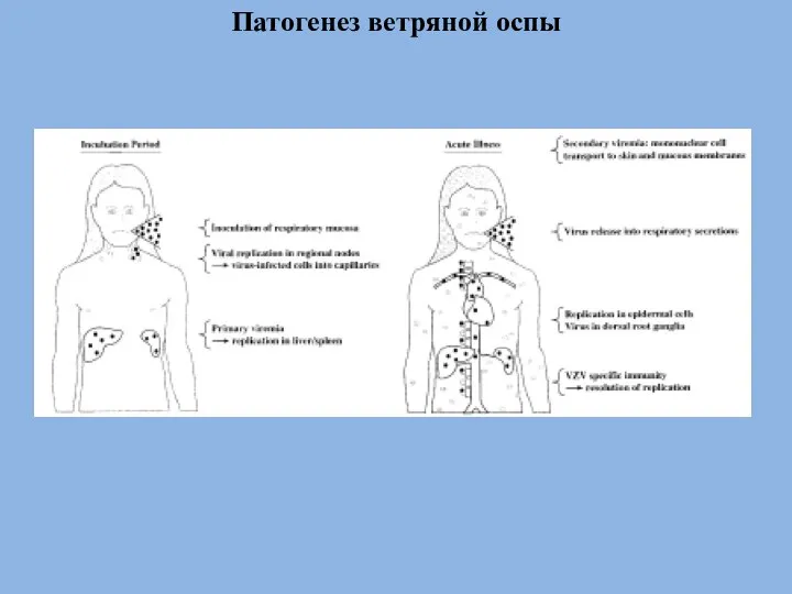 Патогенез ветряной оспы