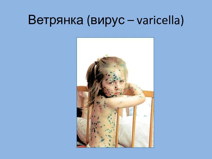 Ветрянка (вирус – varicella)