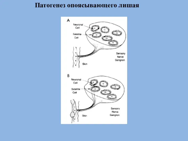 Патогенез опоясывающего лишая