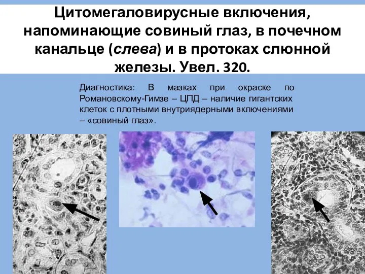 Цитомегаловирусные включения, напоминающие совиный глаз, в почечном канальце (слева) и в