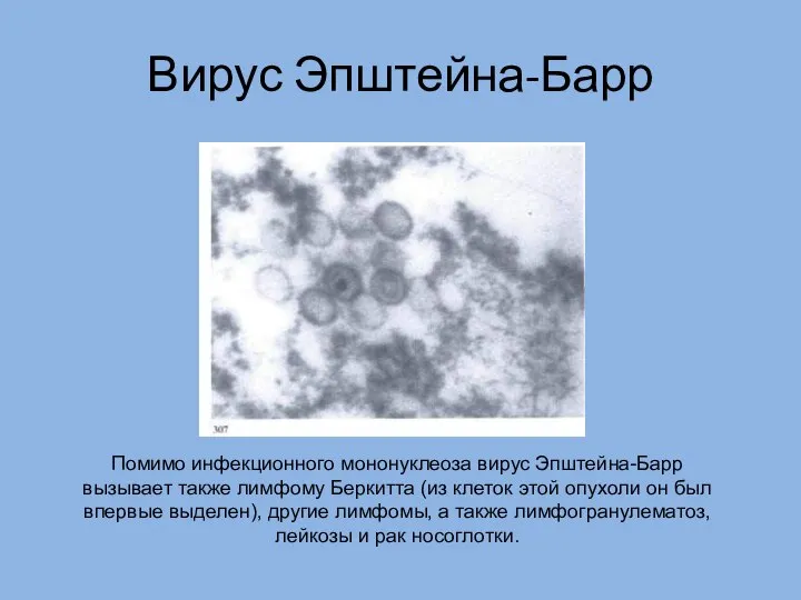 Вирус Эпштейна-Барр Помимо инфекционного мононуклеоза вирус Эпштейна-Барр вызывает также лимфому Беркитта