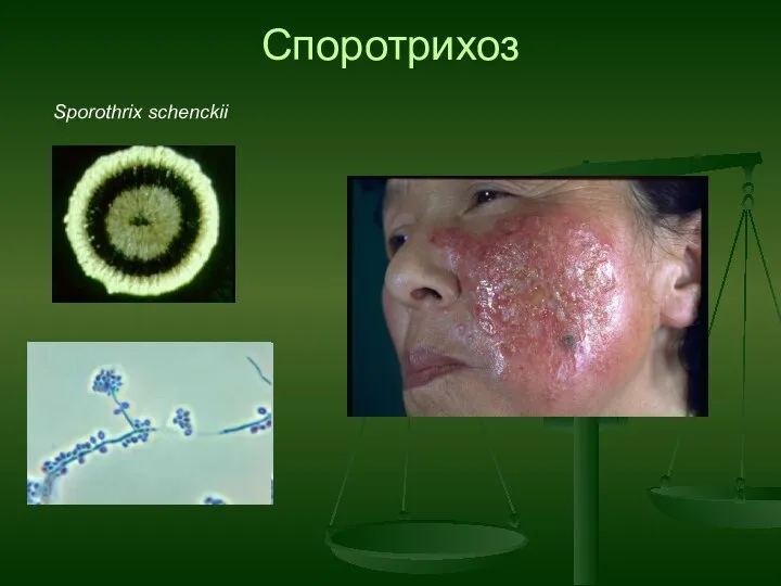 Sporothrix schenckii Споротрихоз