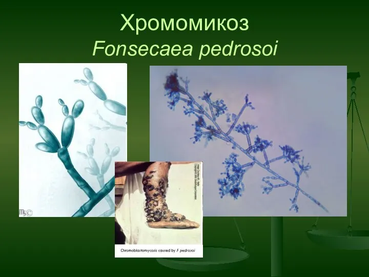 Хромомикоз Fonsecaea pedrosoi