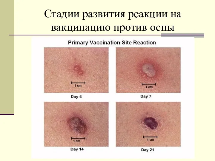 Стадии развития реакции на вакцинацию против оспы