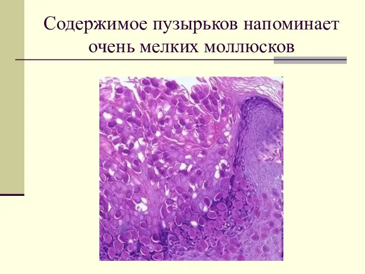 Содержимое пузырьков напоминает очень мелких моллюсков