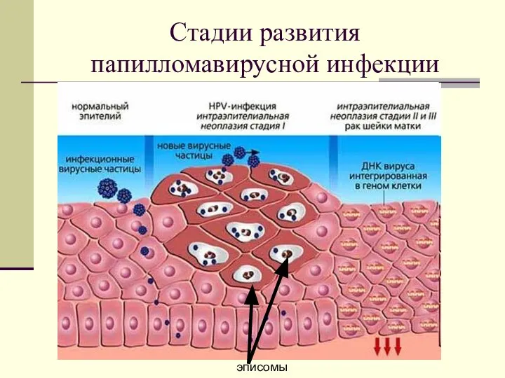 Стадии развития папилломавирусной инфекции эписомы