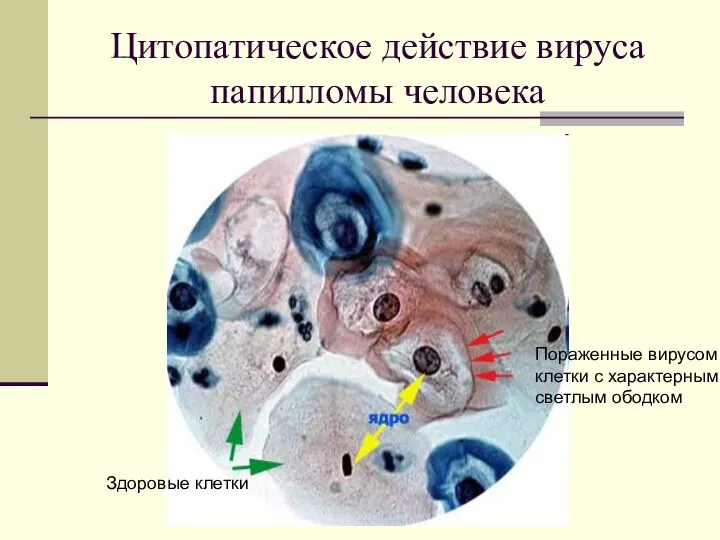 Цитопатическое действие вируса папилломы человека Здоровые клетки Пораженные вирусом клетки с характерным светлым ободком