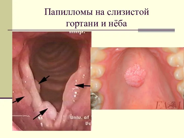 Папилломы на слизистой гортани и нёба