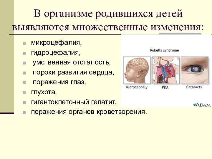 микроцефалия, гидроцефалия, умственная отсталость, пороки развития сердца, поражения глаз, глухота, гигантоклеточный