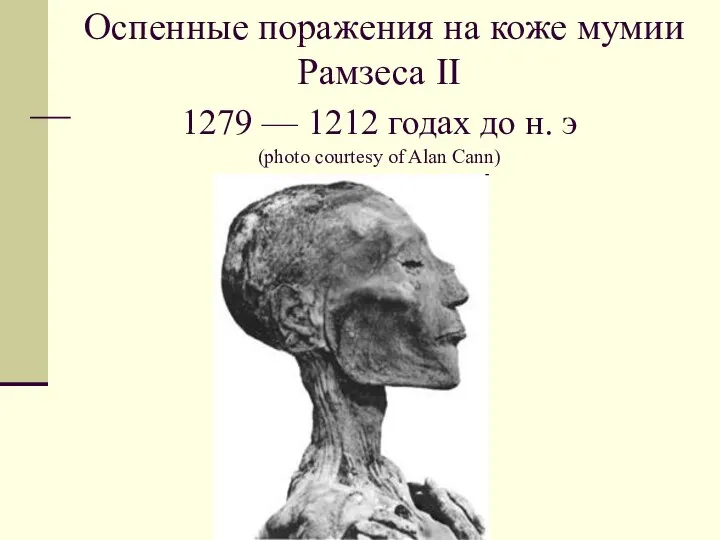 Оспенные поражения на коже мумии Рамзеса II 1279 — 1212 годах