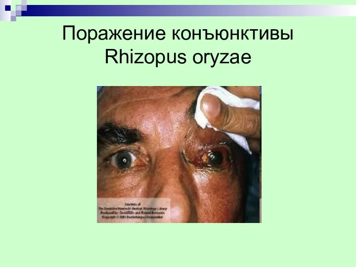 Поражение конъюнктивы Rhizopus oryzae