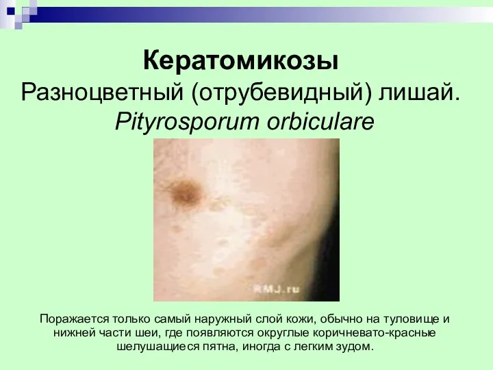 Кератомикозы Разноцветный (отрубевидный) лишай. Pityrosporum orbiculare Поражается только самый наружный слой