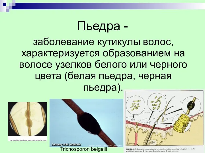 Пьедра - заболевание кутикулы волос, характеризуется образованием на волосе узелков белого