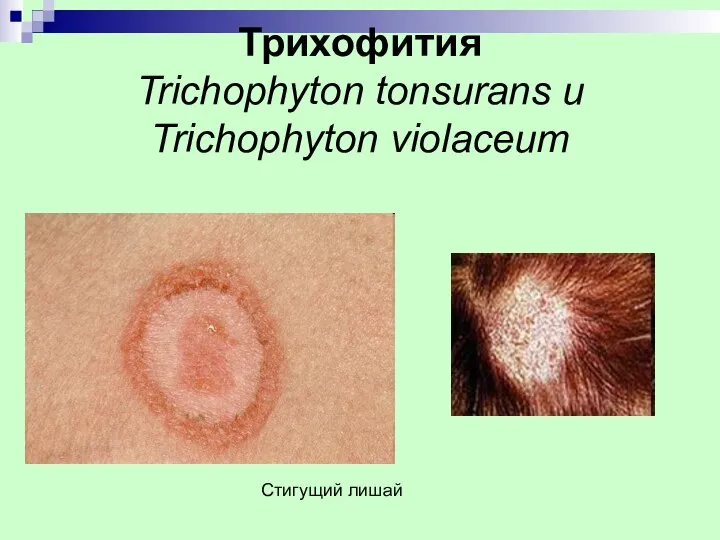 Трихофития Trichophyton tonsurans и Trichophyton violaceum Стигущий лишай