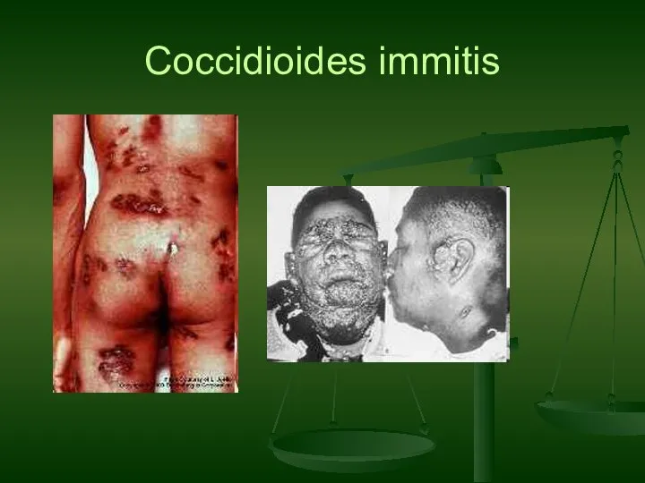 Coccidioides immitis