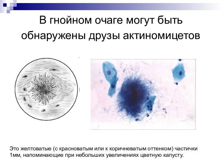 В гнойном очаге могут быть обнаружены друзы актиномицетов Это желтоватые (с