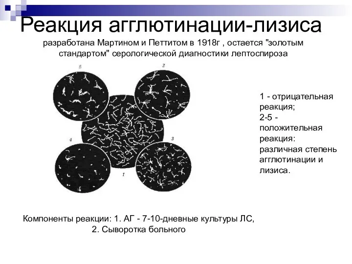 Реакция агглютинации-лизиса 1 - отрицательная реакция; 2-5 - положительная реакция: различная