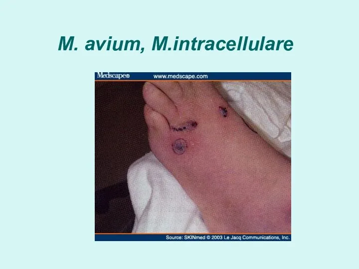 M. avium, M.intracellulare